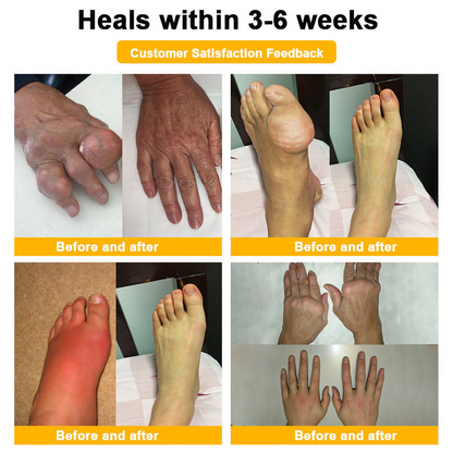 Purelora® Cream with Botulinum Toxin and Bee Venom for Pain Relief and Bone Regeneration