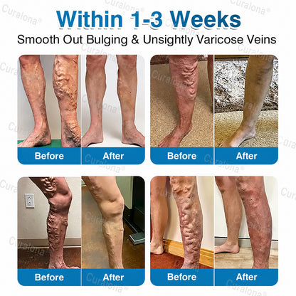 🇬🇧👨‍⚕️✅💙Curalona® VeinRepair Microneedle Patch Roll⚡Instant Relief, Long-Term Results