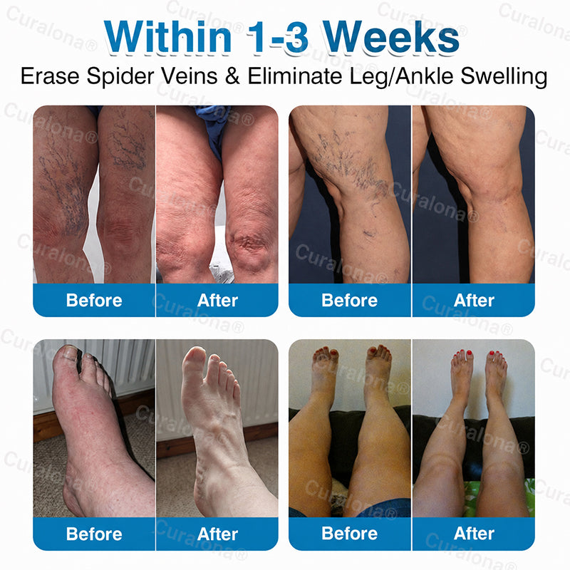 🇬🇧👨‍⚕️✅💙Curalona® VeinRepair Microneedle Patch Roll⚡Instant Relief, Long-Term Results