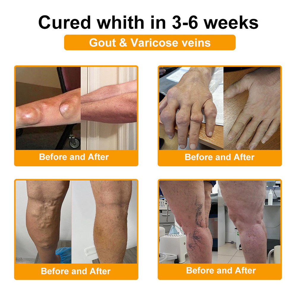 Purelora® Cream with Botulinum Toxin and Bee Venom for Pain Relief and Bone Regeneration