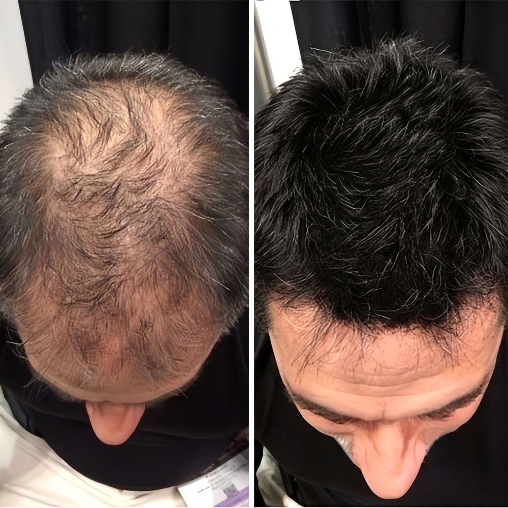 🌿👨‍⚕️ Official UK Flagship Store 🇬🇧 | 🔥PURELORA® Onion & Rosemary 2-in-1 Anti-Hair Loss & Growth Set — Infused with a 15x potent hair-growth active complex to help you achieve thicker, fuller, and stronger hair.