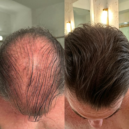 🌿👨‍⚕️ Official UK Flagship Store 🇬🇧 | 🔥PURELORA® Onion & Rosemary 2-in-1 Anti-Hair Loss & Growth Set — Infused with a 15x potent hair-growth active complex to help you achieve thicker, fuller, and stronger hair.