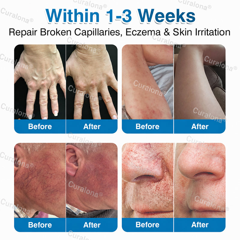 🇬🇧👨‍⚕️✅💙Curalona® VeinRepair Microneedle Patch Roll⚡Instant Relief, Long-Term Results