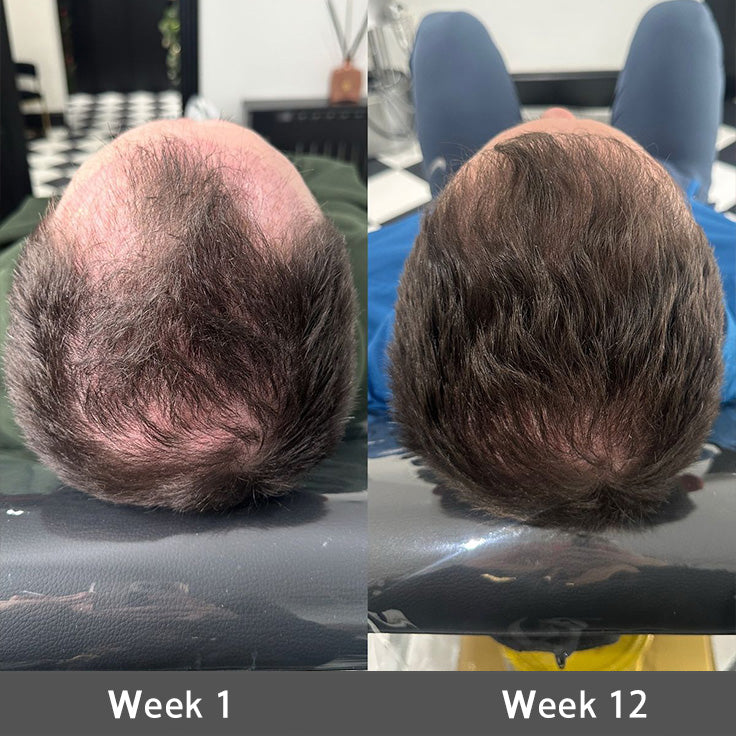 🌿👨‍⚕️ Official UK Flagship Store 🇬🇧 | 🔥PURELORA® Onion & Rosemary 2-in-1 Anti-Hair Loss & Growth Set — Infused with a 15x potent hair-growth active complex to help you achieve thicker, fuller, and stronger hair.