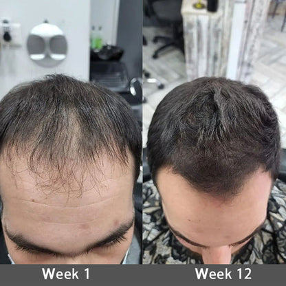 🌿👨‍⚕️ Official UK Flagship Store 🇬🇧 | 🔥PURELORA® Onion & Rosemary 2-in-1 Anti-Hair Loss & Growth Set — Infused with a 15x potent hair-growth active complex to help you achieve thicker, fuller, and stronger hair.