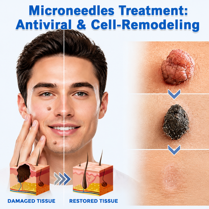 ✨Curalona®2-in-1 Microneedle & Hydrocolloid Patch🍀| Removes Raised Moles, Acne, Flat Warts & Skin Tags | Helps Improve Wrinkles, Scars & Blemishes | Invisible Patches for Face & Body