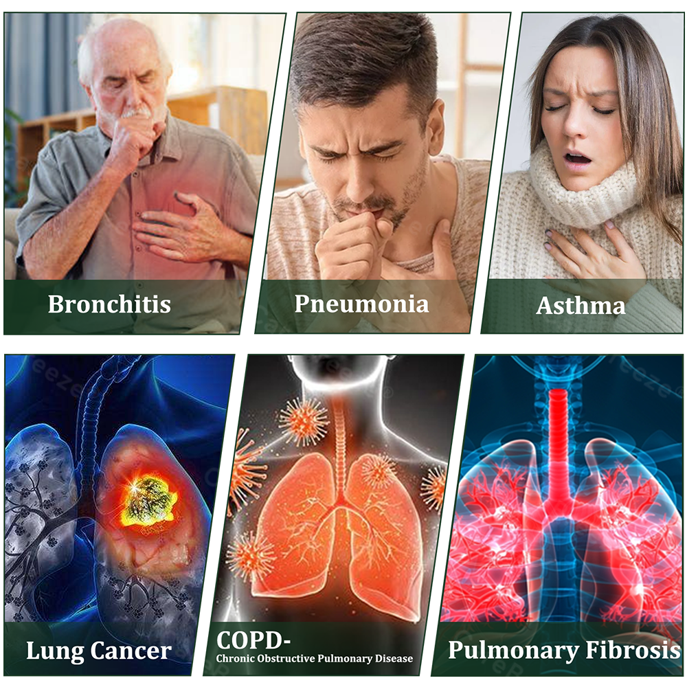 💚🇬🇧 Official Store:Curalona® 6-in-1 Herbal BeePropolis Lung Cleanse Spray🐝（👨‍⚕️Directly acts on COPD, asthma, chronic bronchitis (CB), respiratory infections, lung cancer, sinusitis, and other conditions）